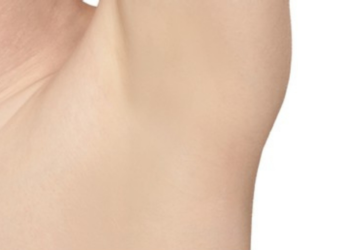 Laser Hair Removal in Dubai