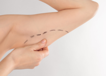 Brachioplasty