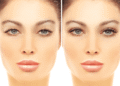 uper and lower blepharoplasty in Dubai