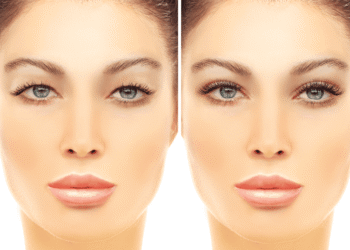 uper and lower blepharoplasty in Dubai