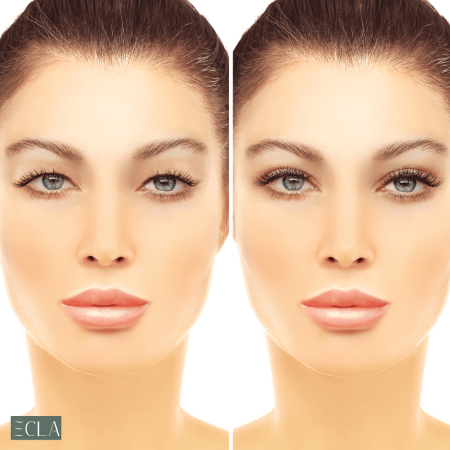 uper and lower blepharoplasty in Dubai