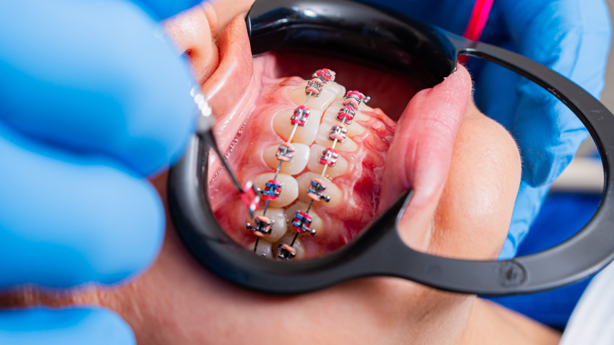 Why Your Teeth Shifted Back After Braces and How to Stop It Happening Again Why Your Teeth Shifted Back After Braces and How to Stop It Happening Again